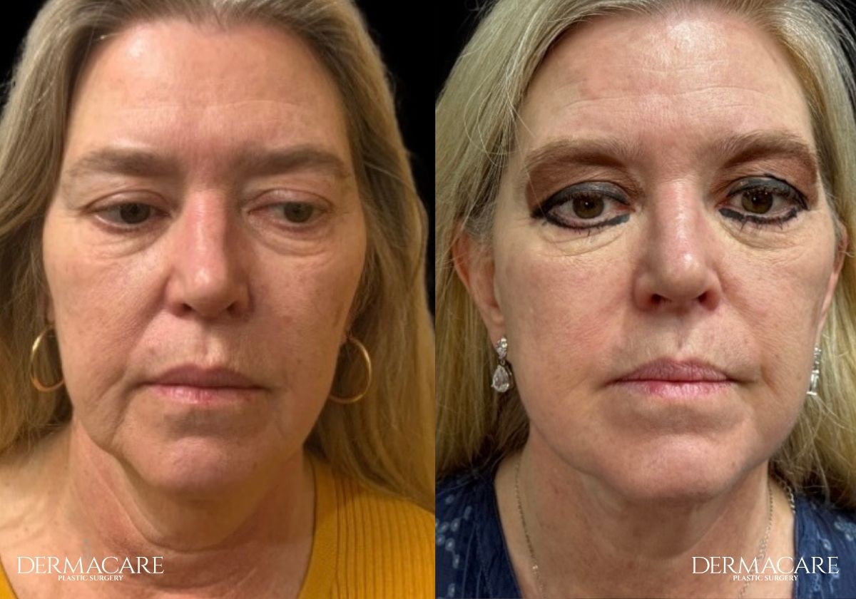 Facelift before after