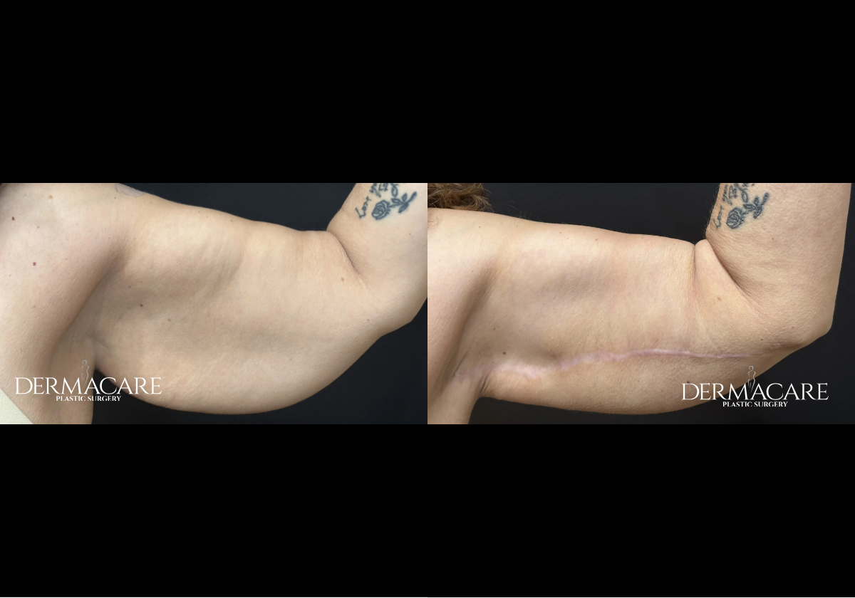 Arm Lift Before and Afters