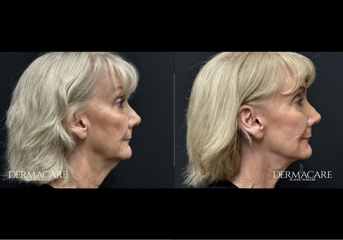 Facelift before after