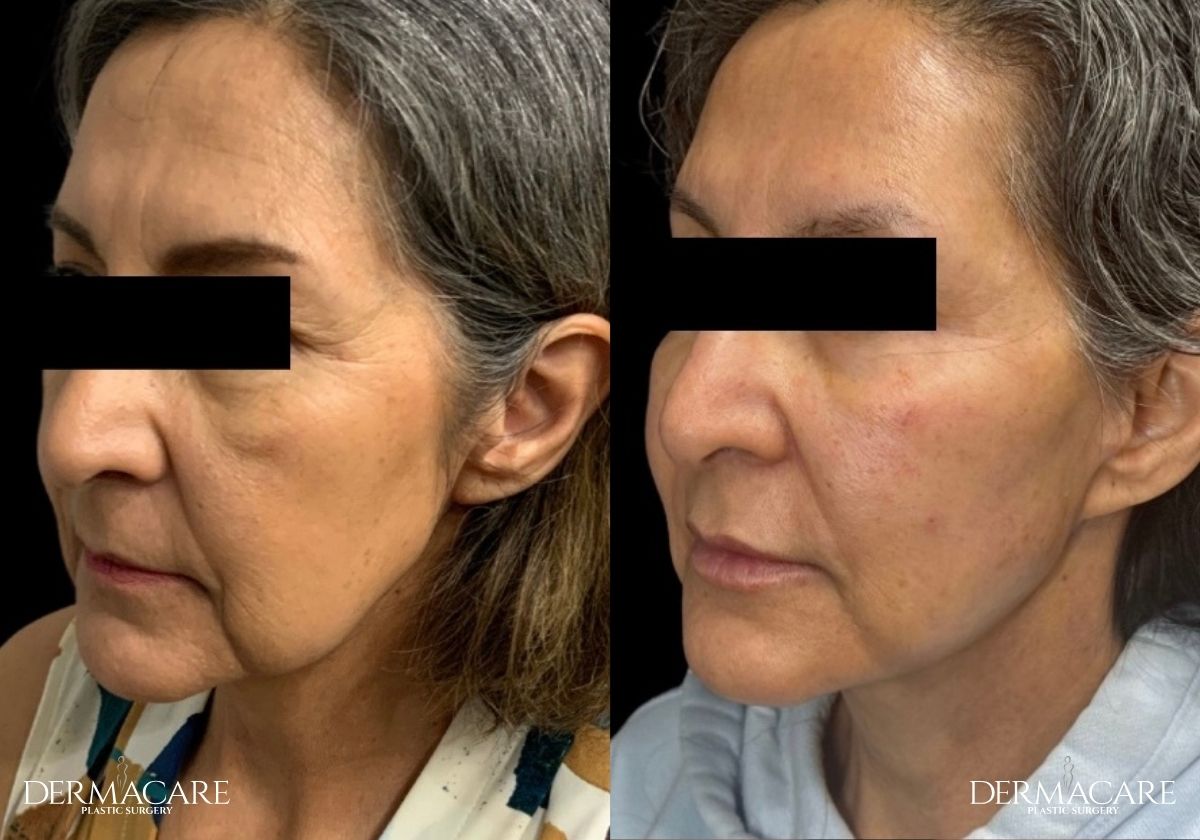 Facelift before after