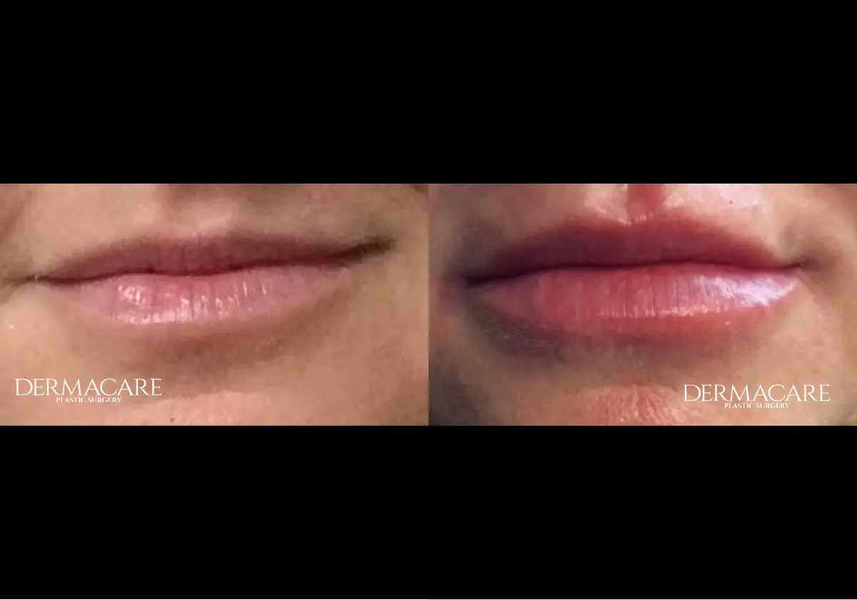 Lip Augmentation Before & After