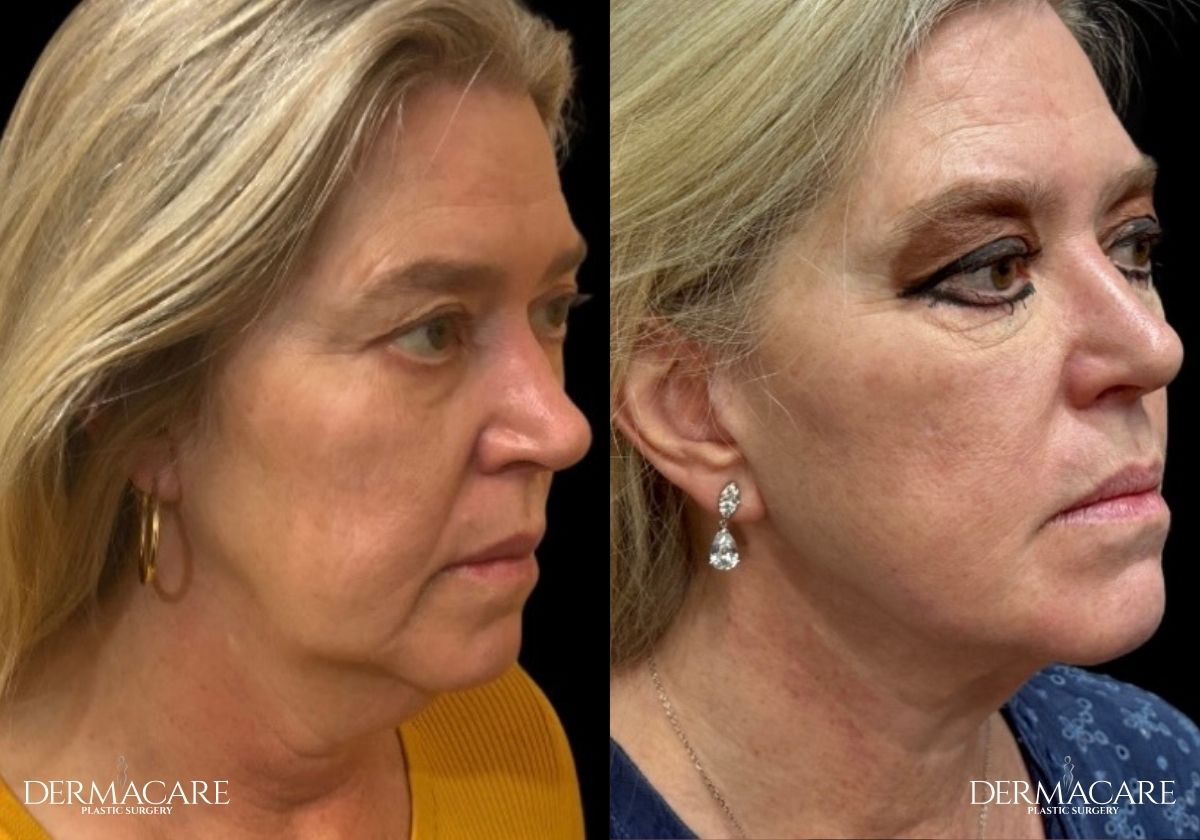 Facelift before after