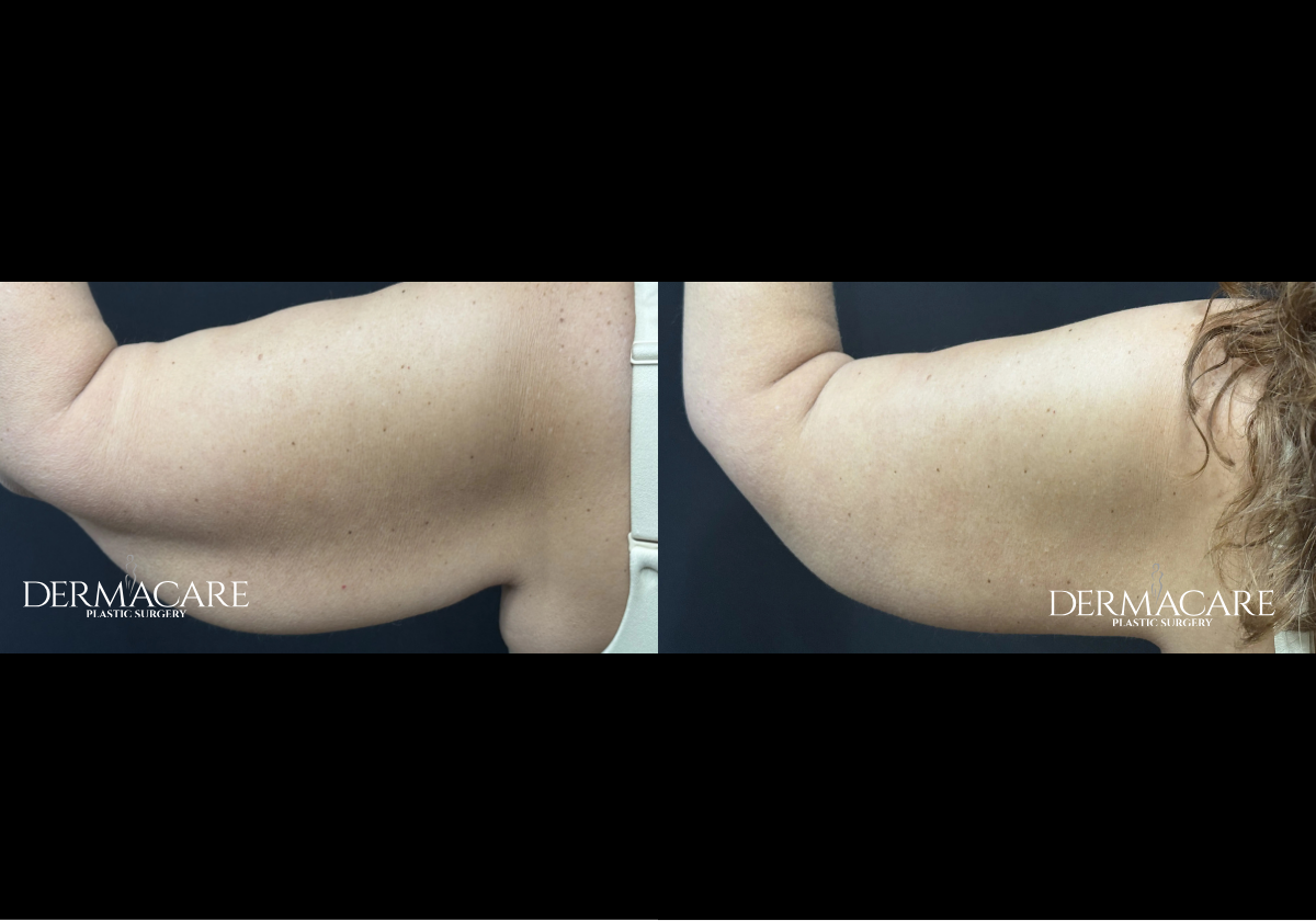 Arm Lift Before and Afters