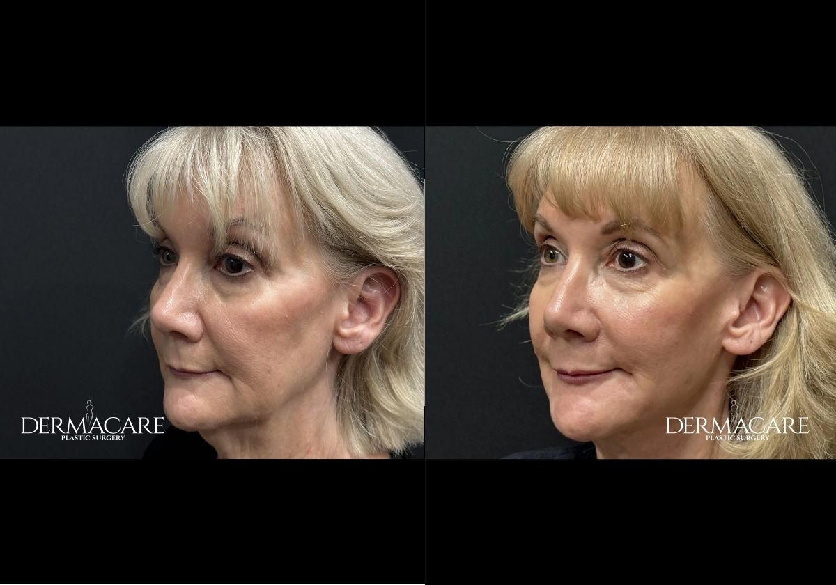 Facelift before after