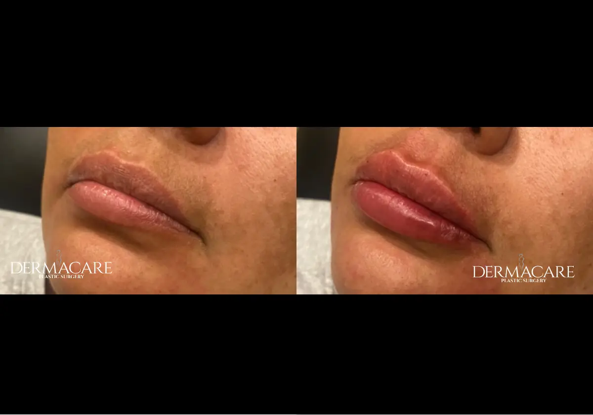 Lip Augmentation Before & After