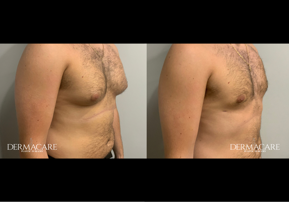 Male Patients Before Afters