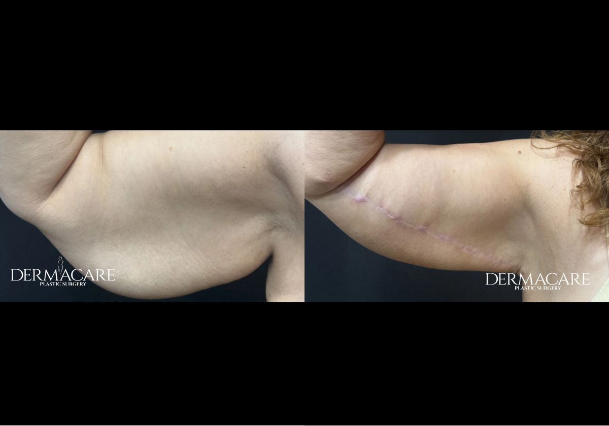 Arm Lift Before and Afters