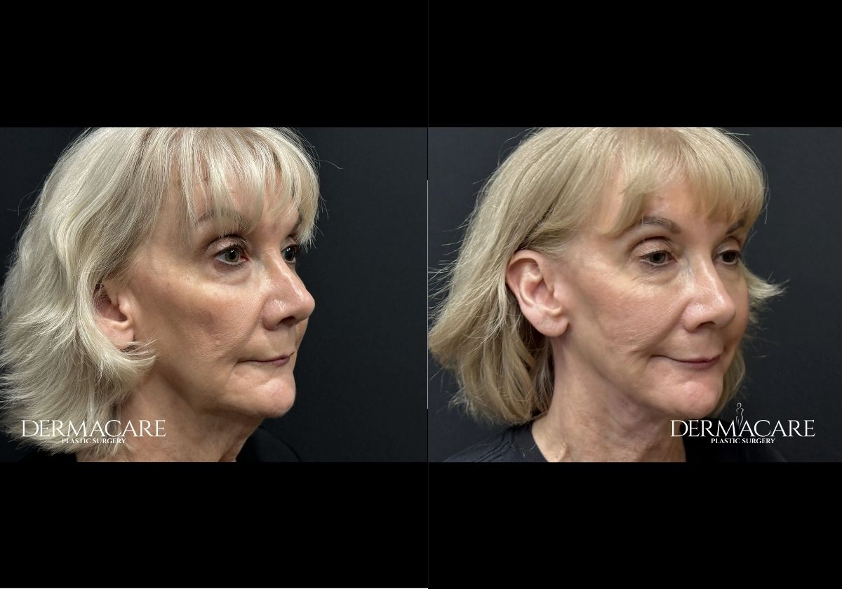 Facelift before after