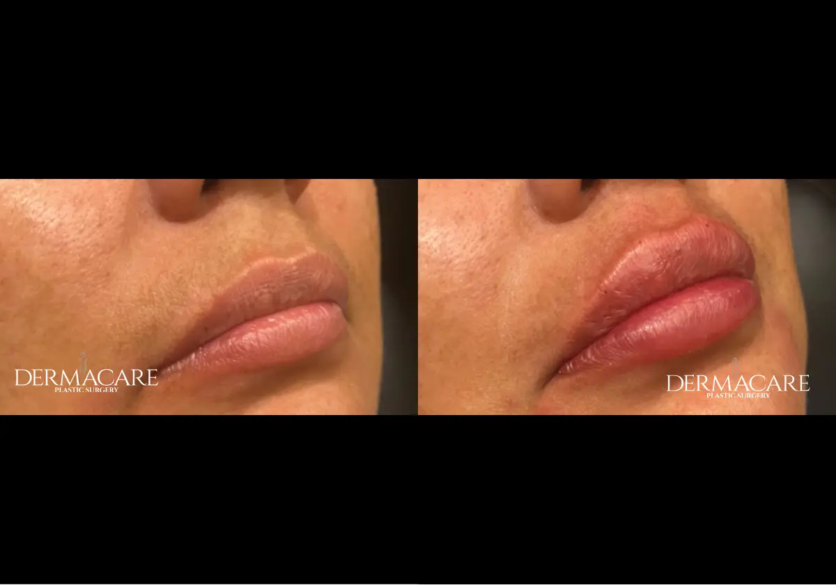 Lip Augmentation Before & After