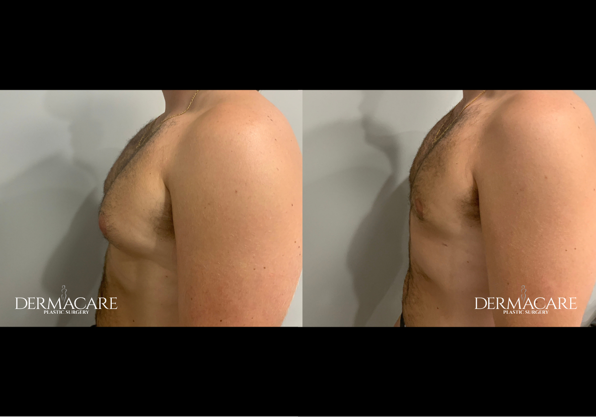 Male Patients Before Afters