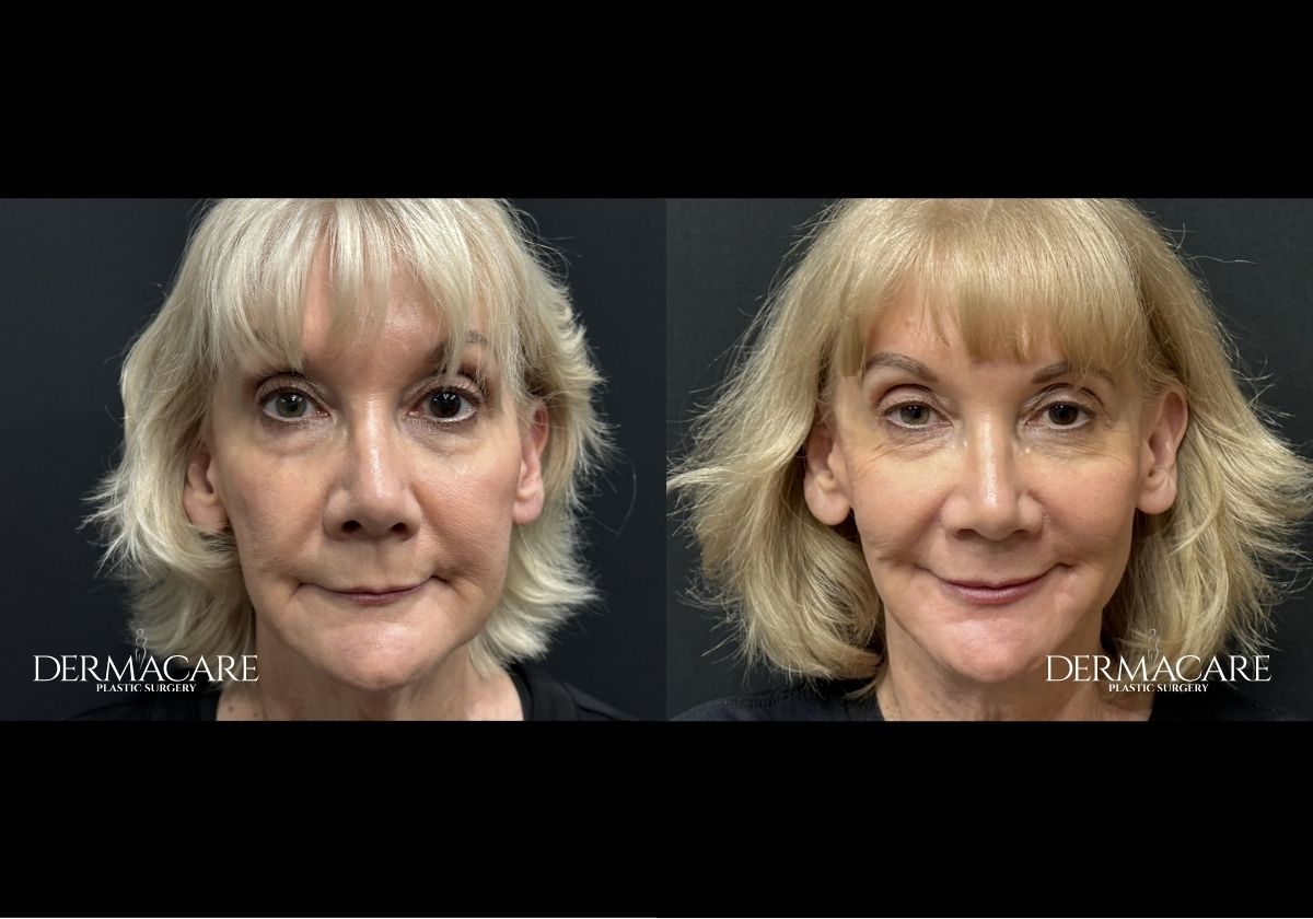 Facelift before after