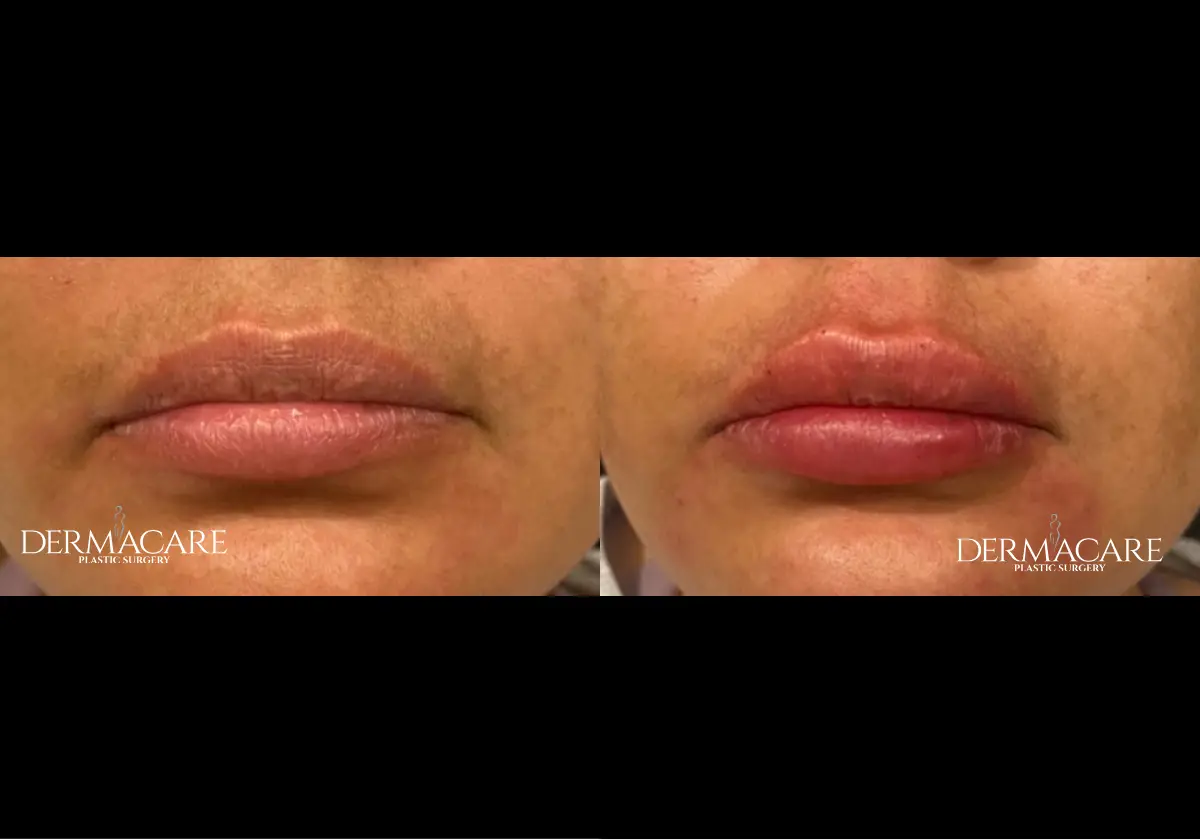 Lip Augmentation Before & After