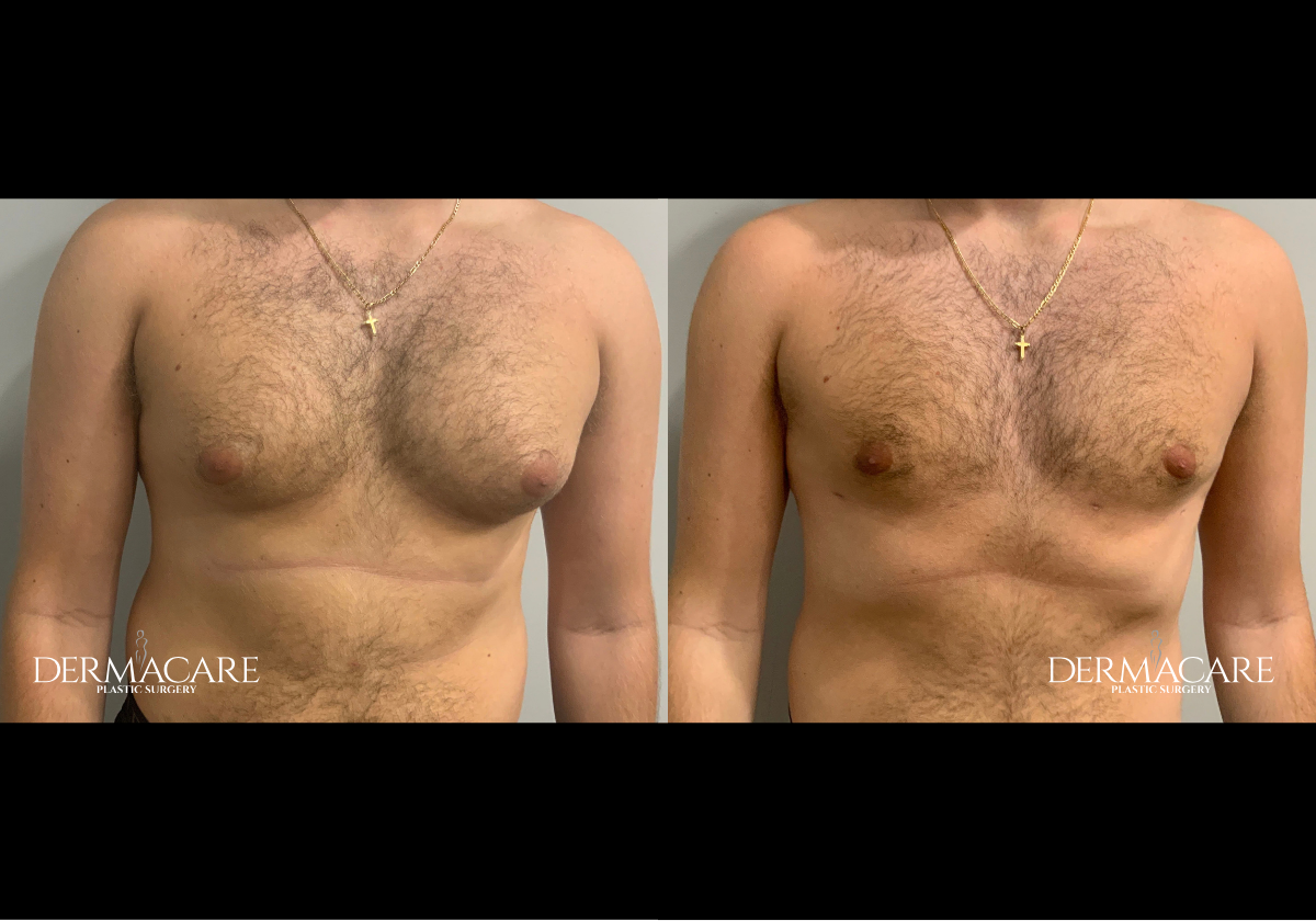 Male Patients Before Afters