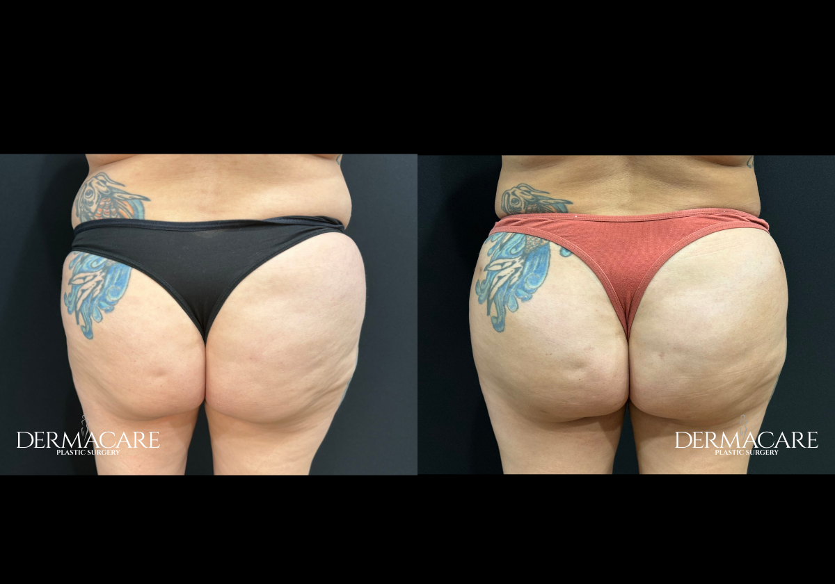 Brazilian Butt Lift Before After