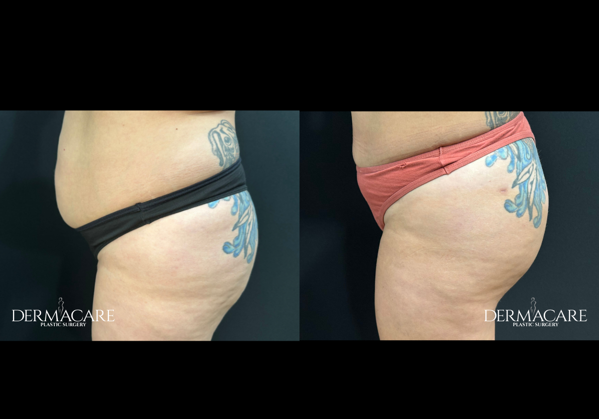 Brazilian Butt Lift Before After