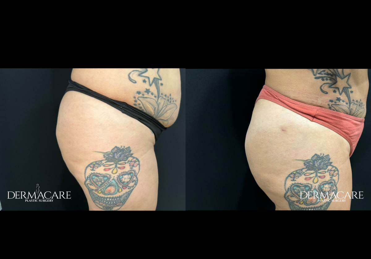Brazilian Butt Lift Before After