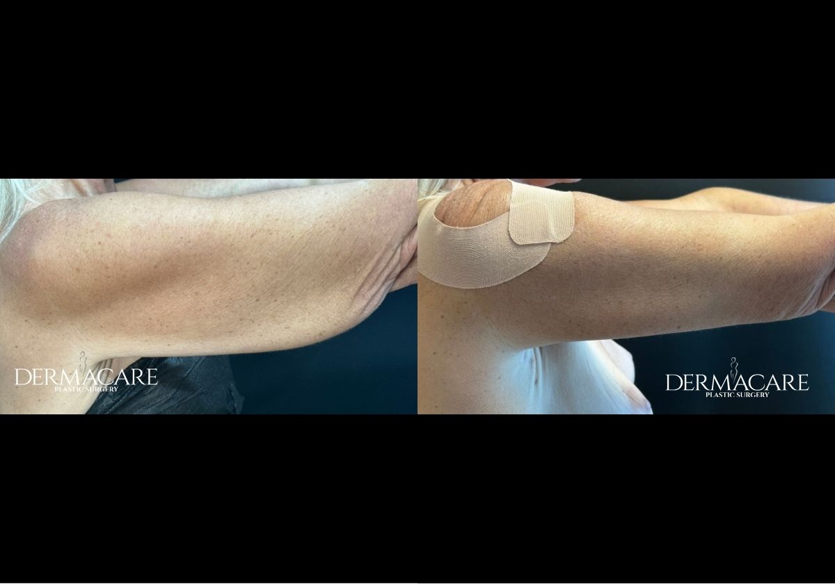 Arm Lift Before and Afters